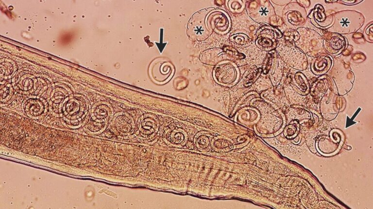 Worms mate in man's eyes, get plucked out right before larvae burst out